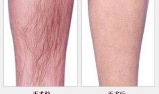 永久性脱毛多少钱