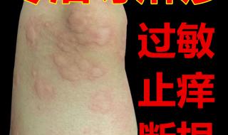 胸腺肽能治疗慢性荨麻疹吗 治疗慢性荨麻疹的药
