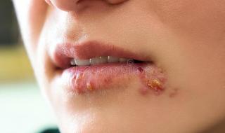 艾滋病红点都长在哪 艾滋病初期红点图片